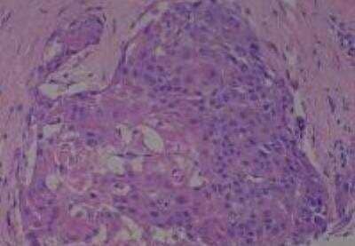 Hematoxylin & Eosin Stain: Human Larynx and Pharynx Tissue MicroArray (Cancer) [NBP2-30270] - 08. Larynx, glottic squamous cell carcinoma