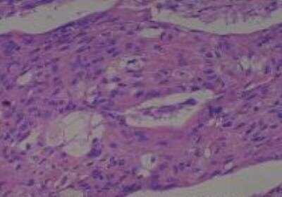 Hematoxylin & Eosin Stain: Human Larynx and Pharynx Tissue MicroArray (Cancer) [NBP2-30270] - 09. Larynx, supraglottic squamous cell carcinoma