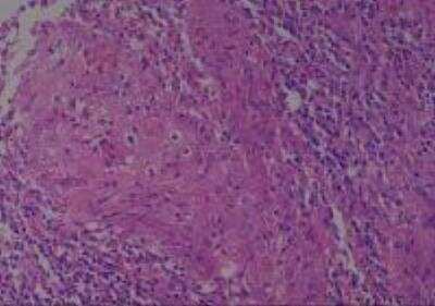 Hematoxylin & Eosin Stain: Human Larynx and Pharynx Tissue MicroArray (Cancer) [NBP2-30270] - 10. Larnyx glottic squamous cell carcinoma