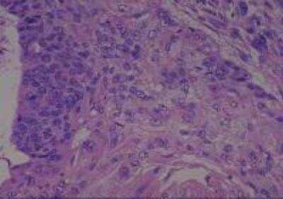 Hematoxylin & Eosin Stain: Human Larynx and Pharynx Tissue MicroArray (Cancer) [NBP2-30270] - 11. Larynx, supraglottic squamous cell