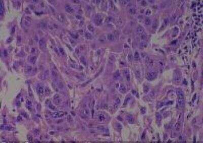 Hematoxylin & Eosin Stain: Human Larynx and Pharynx Tissue MicroArray (Cancer) [NBP2-30270] - 12. Larynx, Pyriform sinus squamous cell