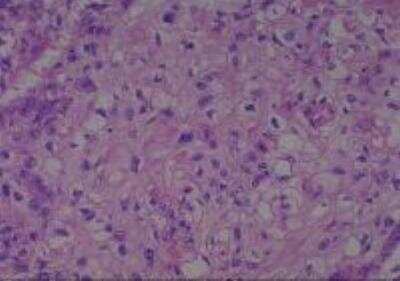 Hematoxylin & Eosin Stain: Human Larynx and Pharynx Tissue MicroArray (Cancer) [NBP2-30270] - 13. Larynx, supraglottic squamous cell carcinoma