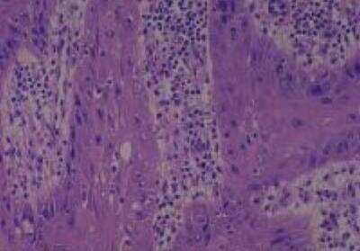 Hematoxylin & Eosin Stain: Human Larynx and Pharynx Tissue MicroArray (Cancer) [NBP2-30270] - 14. Larynx, Transglottic squamous cell carcinoma