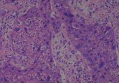 Hematoxylin & Eosin Stain: Human Larynx and Pharynx Tissue MicroArray (Cancer) [NBP2-30270] - 15. Larynx, Supraglottic squamous cell carcinoma