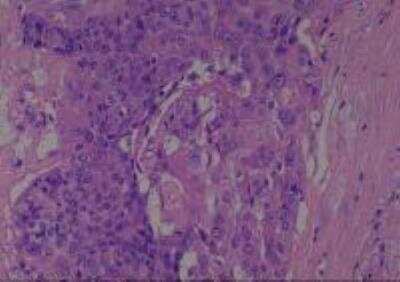 Hematoxylin & Eosin Stain: Human Larynx and Pharynx Tissue MicroArray (Cancer) [NBP2-30270] - 16. Soft tissue, neck, squamous cell carcinoma