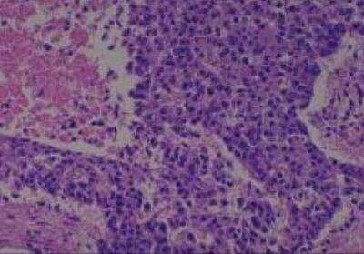 Hematoxylin & Eosin Stain: Human Larynx and Pharynx Tissue MicroArray (Cancer) [NBP2-30270] - 17. Larynx, supraglottic squamous cell carcinoma