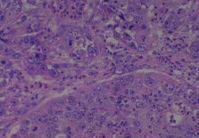 Hematoxylin & Eosin Stain: Human Larynx and Pharynx Tissue MicroArray (Cancer) [NBP2-30270] - 18. Soft tissue, neck squamous cell