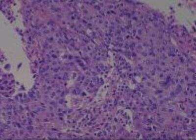 Hematoxylin & Eosin Stain: Human Larynx and Pharynx Tissue MicroArray (Cancer) [NBP2-30270] - 19. Larynx, supraglottic squamous cell carcinoma