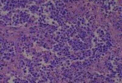 Hematoxylin & Eosin Stain: Human Larynx and Pharynx Tissue MicroArray (Cancer) [NBP2-30270] - 20. Nasal cavity and undifferentiated carcinoma