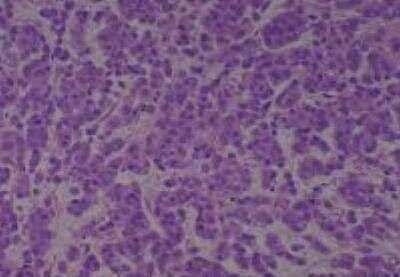 Hematoxylin & Eosin Stain: Human Larynx and Pharynx Tissue MicroArray (Cancer) [NBP2-30270] - 21. Larynx, Transglottic squamous cell carcinoma