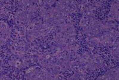 Hematoxylin & Eosin Stain: Human Larynx and Pharynx Tissue MicroArray (Cancer) [NBP2-30270] - 22. Lymph node metastic undifferentiated