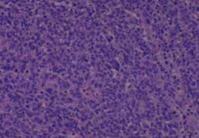 Hematoxylin & Eosin Stain: Human Larynx and Pharynx Tissue MicroArray (Cancer) [NBP2-30270] - 23. Nasopharynx, Undifferentiated carcinoma