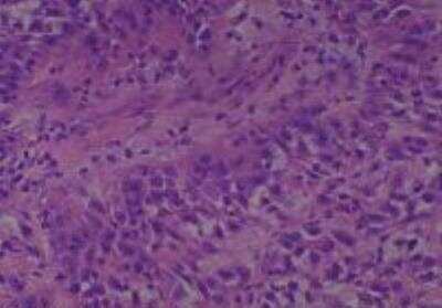 Hematoxylin & Eosin Stain: Human Larynx and Pharynx Tissue MicroArray (Cancer) [NBP2-30270] - 24. Neck, Undifferentiated carcinoma