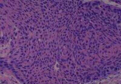 Hematoxylin & Eosin Stain: Human Larynx and Pharynx Tissue MicroArray (Cancer) [NBP2-30270] - 25. Larynx, Transglottic squamous cell carcinoma