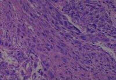 Hematoxylin & Eosin Stain: Human Larynx and Pharynx Tissue MicroArray (Cancer) [NBP2-30270] - 26. Neck squamous cell carcinoma, Moderately differentiated