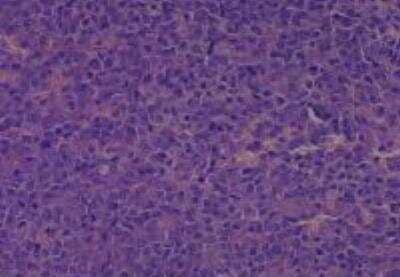 Hematoxylin & Eosin Stain: Human Larynx and Pharynx Tissue MicroArray (Cancer) [NBP2-30270] - 27. Nasal cavity, Squamous cell carcinoma