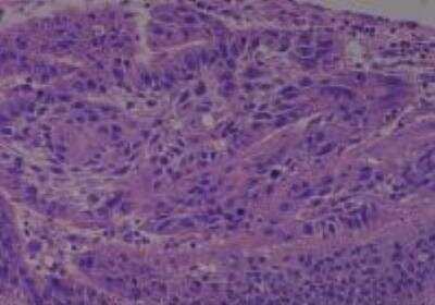 Hematoxylin & Eosin Stain: Human Larynx and Pharynx Tissue MicroArray (Cancer) [NBP2-30270] - 28.  Larynx, subglottic squamous cell carcinoma, moderately differentiated