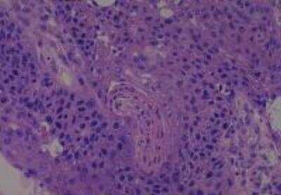 Hematoxylin & Eosin Stain: Human Larynx and Pharynx Tissue MicroArray (Cancer) [NBP2-30270] - 29. Larynx, transglottic squamous cell carcinoma, well differentiated