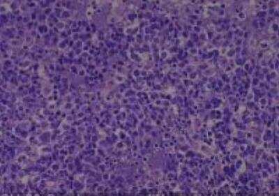 Hematoxylin & Eosin Stain: Human Larynx and Pharynx Tissue MicroArray (Cancer) [NBP2-30270] - 30. Oropharynx undifferentiated carcinoma