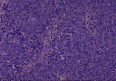 Hematoxylin & Eosin Stain: Human Larynx and Pharynx Tissue MicroArray (Cancer) [NBP2-30270] - 31. Hypopharynx squamous cell carcinoma, poorly differentiated