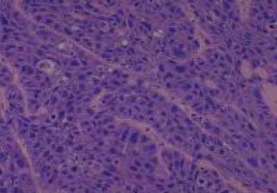 Hematoxylin & Eosin Stain: Human Larynx and Pharynx Tissue MicroArray (Cancer) [NBP2-30270] - 32. Larynx, pyriform sinus squamous cell carcinoma