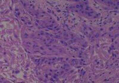 Hematoxylin & Eosin Stain: Human Larynx and Pharynx Tissue MicroArray (Cancer) [NBP2-30270] - 33. Soft tissue, neck squamous cell carcinoma (from larynx)