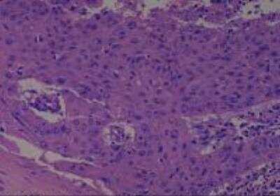 Hematoxylin & Eosin Stain: Human Larynx and Pharynx Tissue MicroArray (Cancer) [NBP2-30270] - 35. Larynx subglottic squamos cell carcinoma