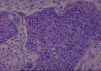 Hematoxylin & Eosin Stain: Human Larynx and Pharynx Tissue MicroArray (Cancer) [NBP2-30270] - 36. Larynx supraglottic squamos cell