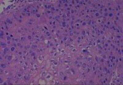 Hematoxylin & Eosin Stain: Human Larynx and Pharynx Tissue MicroArray (Cancer) [NBP2-30270] - 37. Larynx, supraglottic squamous cell carcinoma, well differentiated