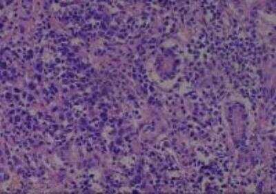 Hematoxylin & Eosin Stain: Human Larynx and Pharynx Tissue MicroArray (Cancer) [NBP2-30270] - 38. Submandibular gland undifferentiated carcinoma