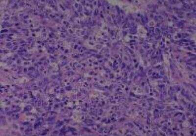 Hematoxylin & Eosin Stain: Human Larynx and Pharynx Tissue MicroArray (Cancer) [NBP2-30270] - 39. Tonsil squamous cell carcinoma, poorly differentiated