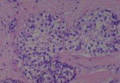 Hematoxylin & Eosin Stain: Human Larynx and Pharynx Tissue MicroArray (Cancer) [NBP2-30270] - 40. Nose squamous cell carcinoma, poorly differentiated