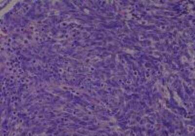 Hematoxylin & Eosin Stain: Human Larynx and Pharynx Tissue MicroArray (Cancer) [NBP2-30270] - 42. Skin, neck undifferentiated carcinoma (from nasopharynx)