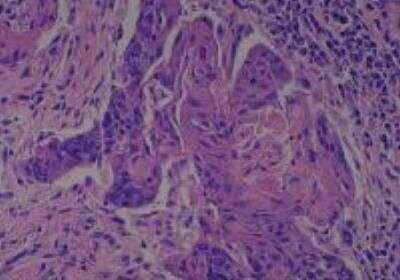 Hematoxylin & Eosin Stain: Human Larynx and Pharynx Tissue MicroArray (Cancer) [NBP2-30270] - 43. Larynx, supraglottic squamous cell carcinoma, moderately differentiated