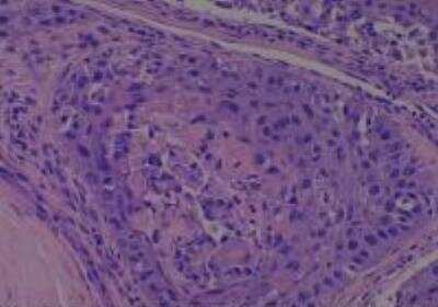 Hematoxylin & Eosin Stain: Human Larynx and Pharynx Tissue MicroArray (Cancer) [NBP2-30270] - 44. Larynx, subglottic squamous cell carcinoma