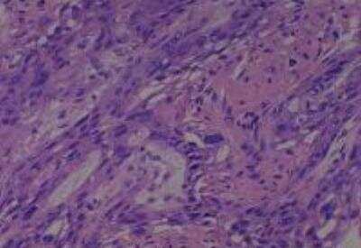 Hematoxylin & Eosin Stain: Human Larynx and Pharynx Tissue MicroArray (Cancer) [NBP2-30270] - 48. Larynx, glottic squamous cell carcinoma