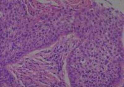 Hematoxylin & Eosin Stain: Human Larynx and Pharynx Tissue MicroArray (Cancer) [NBP2-30270] - 50. Larynx, supraglottic squamous cell carcinoma