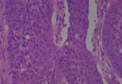 Hematoxylin & Eosin Stain: Human Larynx and Pharynx Tissue MicroArray (Cancer) [NBP2-30270] - 51. Larynx, pyriform sinus squamous cell carcinoma