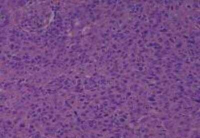 Hematoxylin & Eosin Stain: Human Larynx and Pharynx Tissue MicroArray (Cancer) [NBP2-30270] - 52. Maxilla undifferentiated carcinoma