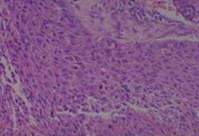 Hematoxylin & Eosin Stain: Human Larynx and Pharynx Tissue MicroArray (Cancer) [NBP2-30270] - 53.Larynx, glottic squamous cell carcinoma, well differentiated