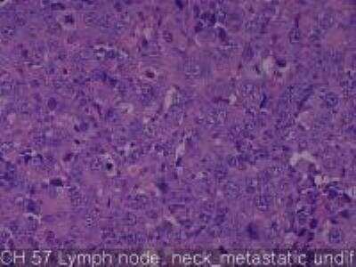 Hematoxylin & Eosin Stain: Human Larynx and Pharynx Tissue MicroArray (Cancer) [NBP2-30270] - 57.Lymph node, neck metastatic undifferentiated carcinoma, (primary site unknown)