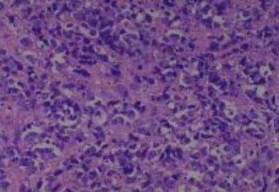 Hematoxylin & Eosin Stain: Human Larynx and Pharynx Tissue MicroArray (Cancer) [NBP2-30270] - 59.Larynx, supraglottic squamous cell carcinoma, poorly differentiated