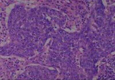 Hematoxylin & Eosin Stain: Human Larynx and Pharynx Tissue MicroArray (Cancer) [NBP2-30270] - 58. Larynx, glottic squamous cell carcinoma, poorly differentiated