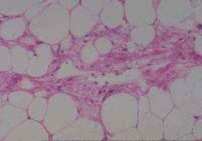 Hematoxylin & Eosin Stain: Human Lipomatous Tissue MicroArray (Tumor) [NBP2-30241] -  06. Kidney, Angiomyolipoma