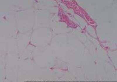 Hematoxylin & Eosin Stain: Human Lipomatous Tissue MicroArray (Tumor) [NBP2-30241] -  09. Soft Tissue, Back Lipoma