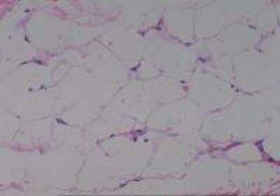 Hematoxylin & Eosin Stain: Human Lipomatous Tissue MicroArray (Tumor) [NBP2-30241] - 11. Soft tissue, neck Lipoma