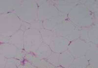 Hematoxylin & Eosin Stain: Human Lipomatous Tissue MicroArray (Tumor) [NBP2-30241] - 14. Soft Tissue, axila Lipoma