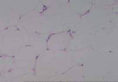 Hematoxylin & Eosin Stain: Human Lipomatous Tissue MicroArray (Tumor) [NBP2-30241] - 15. Soft Tissue, thigh Lipoma