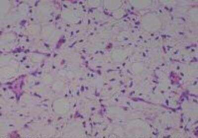 Hematoxylin & Eosin Stain: Human Lipomatous Tissue MicroArray (Tumor) [NBP2-30241] -  18. Soft tissue, abdomen liposarcoma