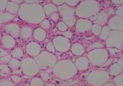 Hematoxylin & Eosin Stain: Human Lipomatous Tissue MicroArray (Tumor) [NBP2-30241] - 19. Soft Tissue, Neck Liposarcoma, Well differentiated